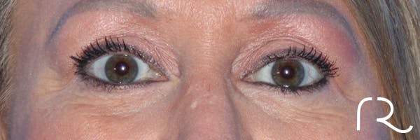 Eyelid Surgery Before & After Gallery - Patient 177905314 - Image 4