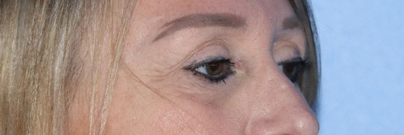 Eyelid Surgery Before & After Gallery - Patient 177905314 - Image 5