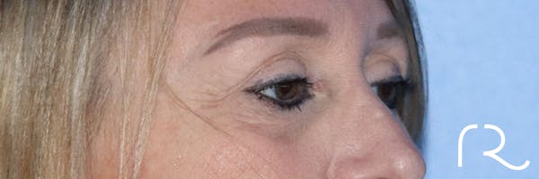 Eyelid Surgery Before & After Gallery - Patient 177905314 - Image 5