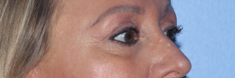 Eyelid Surgery Before & After Gallery - Patient 177905314 - Image 6