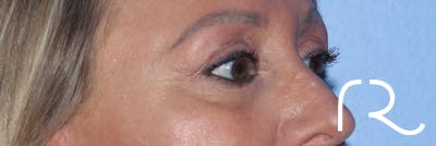 Eyelid Surgery Before & After Gallery - Patient 177905314 - Image 6