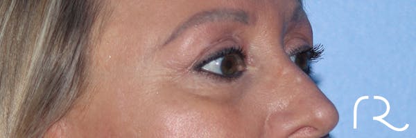Eyelid Surgery Before & After Gallery - Patient 177905314 - Image 6