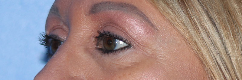 Eyelid Surgery Before & After Gallery - Patient 177905314 - Image 8