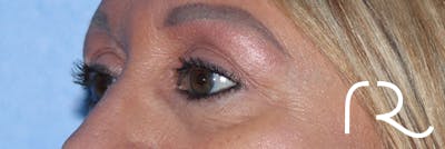 Eyelid Surgery Before & After Gallery - Patient 177905314 - Image 8