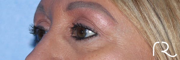 Eyelid Surgery Before & After Gallery - Patient 177905314 - Image 8