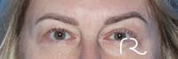 Eyelid Surgery Before & After Gallery - Patient 185642339 - Image 1