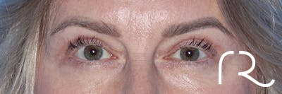 Eyelid Surgery Before & After Gallery - Patient 185642339 - Image 2