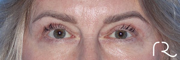 Eyelid Surgery Before & After Gallery - Patient 185642339 - Image 2