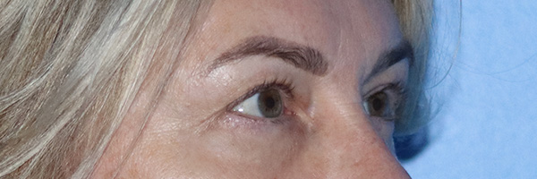 Eyelid Surgery Before & After Gallery - Patient 185642339 - Image 3