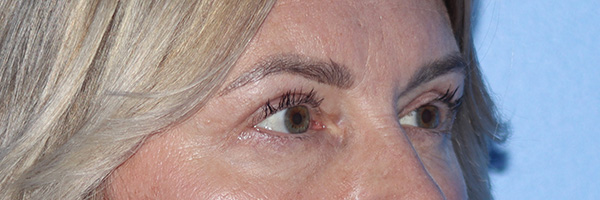 Eyelid Surgery Before & After Gallery - Patient 185642339 - Image 4