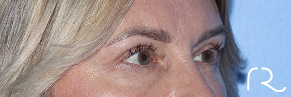 Eyelid Surgery Before & After Gallery - Patient 185642339 - Image 4