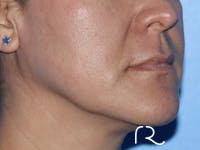 Lip Lift Before & After Gallery - Patient 185642357 - Image 1