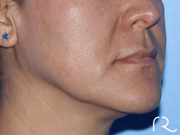 Lip Lift Before & After Gallery - Patient 185642357 - Image 1