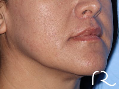 Lip Lift Before & After Gallery - Patient 185642357 - Image 2