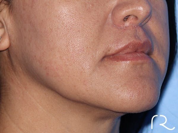 Lip Lift Before & After Gallery - Patient 185642357 - Image 2