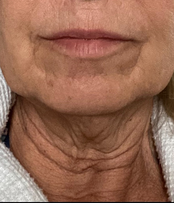 Neck Lift Before & After Gallery - Patient 185642437 - Image 1