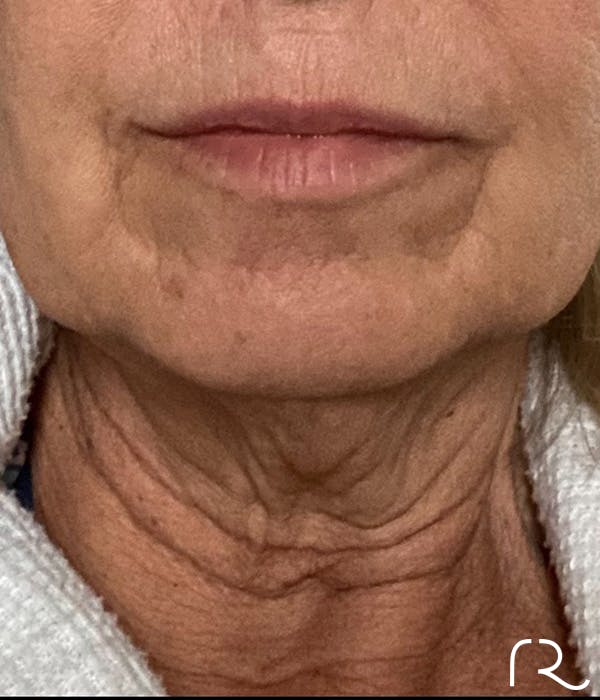 Neck Lift Before & After Gallery - Patient 185642437 - Image 1