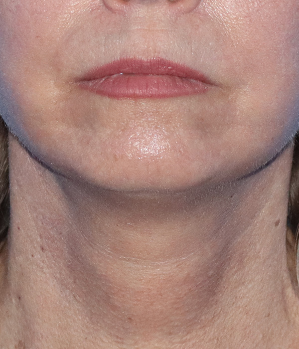Facelift Before & After Gallery - Patient 185642372 - Image 2