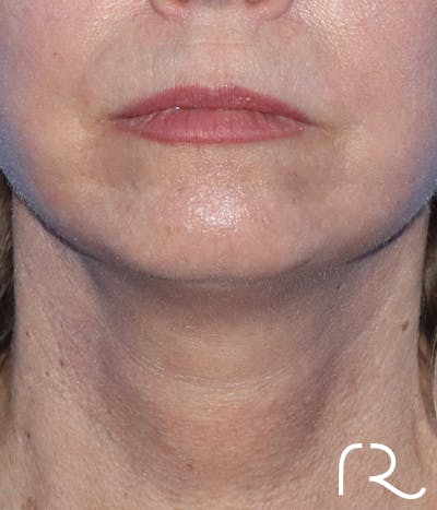 Neck Lift Before & After Gallery - Patient 185642437 - Image 2
