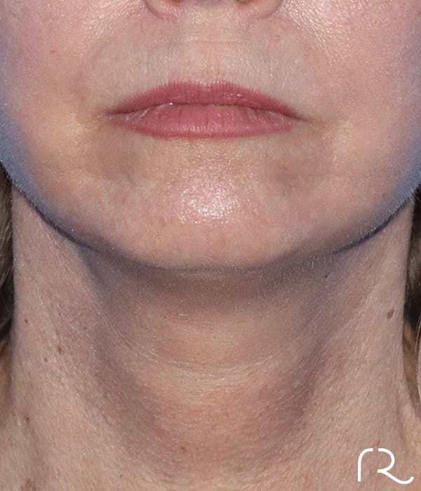 Facelift Before & After Gallery - Patient 185642372 - Image 2