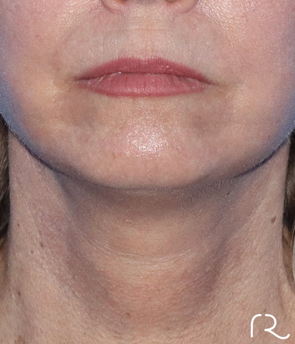 Neck Lift Before & After Gallery - Patient 185642437 - Image 2