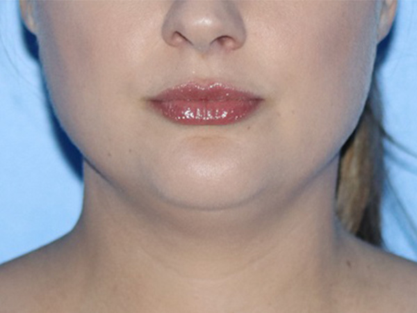 Buccal Fat Removal Before & After Gallery - Patient 116998 - Image 1