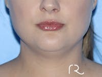Buccal Fat Removal Before & After Gallery - Patient 116998 - Image 1