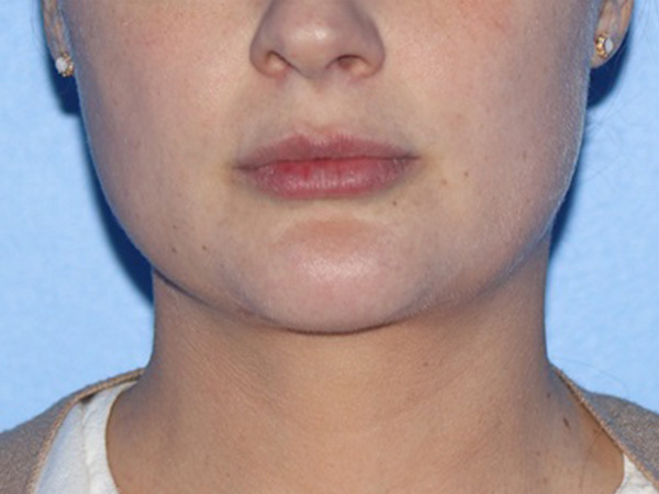 Buccal Fat Removal Before & After Gallery - Patient 116998 - Image 2