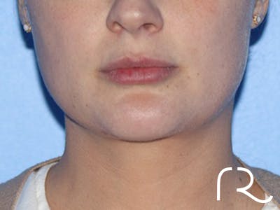 Buccal Fat Removal Before & After Gallery - Patient 116998 - Image 2