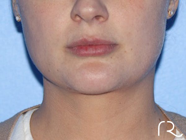 Neck Lift Before & After Gallery - Patient 337258 - Image 4