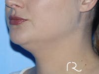 Neck Lift Before & After Gallery - Patient 337258 - Image 1