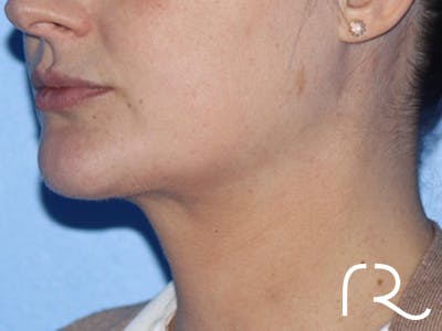 Neck Lift Before & After Gallery - Patient 337258 - Image 2