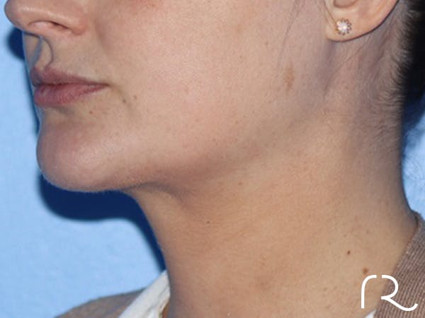 Buccal Fat Removal Before & After Gallery - Patient 116998 - Image 4