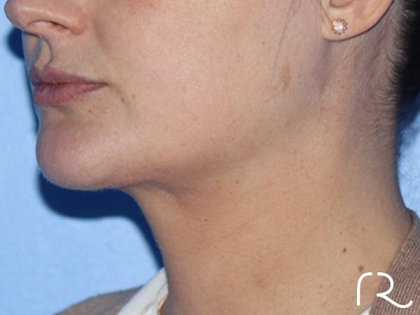 Neck Lift Before & After Gallery - Patient 337258 - Image 2