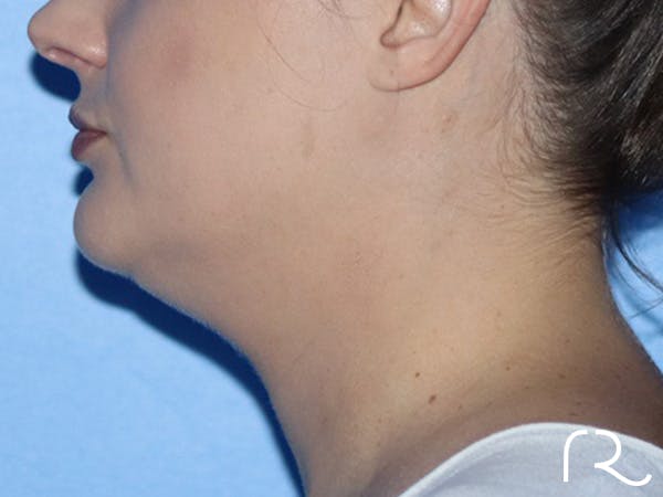 Neck Lift Before & After Gallery - Patient 337258 - Image 5