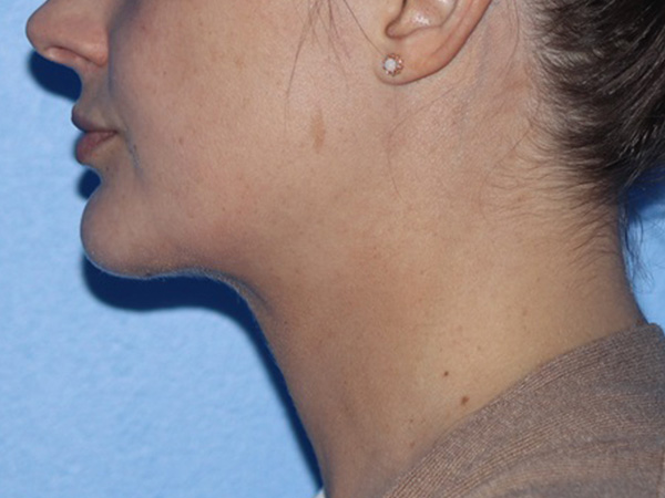 Buccal Fat Removal Before & After Gallery - Patient 116998 - Image 6