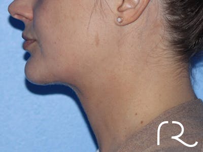 Buccal Fat Removal Before & After Gallery - Patient 116998 - Image 6