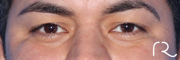 Eyelid Surgery Before & After Gallery - Patient 327450 - Image 1