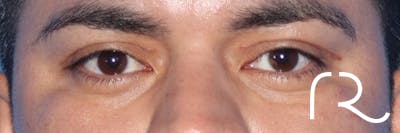 Eyelid Surgery Before & After Gallery - Patient 327450 - Image 2