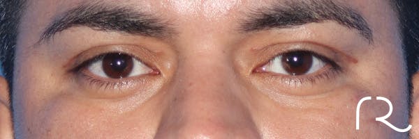 Eyelid Surgery Before & After Gallery - Patient 327450 - Image 2