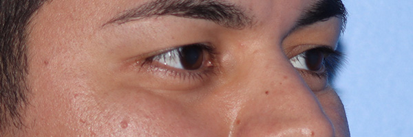 Eyelid Surgery Before & After Gallery - Patient 327450 - Image 3
