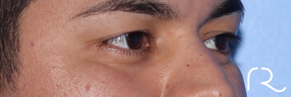 Eyelid Surgery Before & After Gallery - Patient 327450 - Image 3