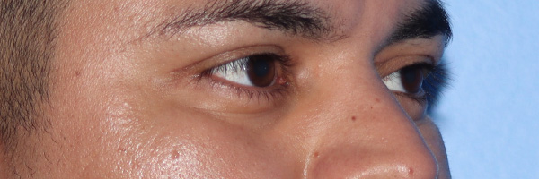 Eyelid Surgery Before & After Gallery - Patient 327450 - Image 4