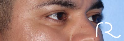 Eyelid Surgery Before & After Gallery - Patient 327450 - Image 4