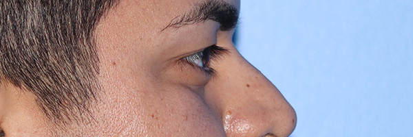 Eyelid Surgery Before & After Gallery - Patient 327450 - Image 5