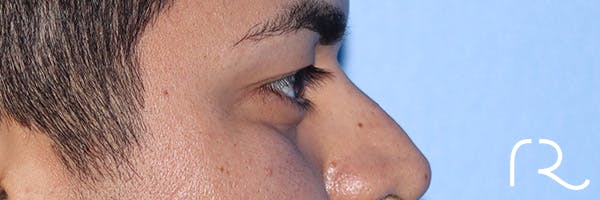 Eyelid Surgery Before & After Gallery - Patient 327450 - Image 5