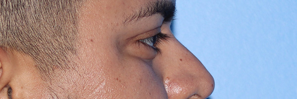 Eyelid Surgery Before & After Gallery - Patient 327450 - Image 6