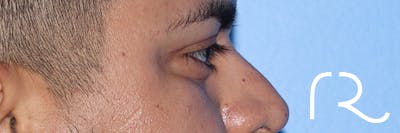 Eyelid Surgery Before & After Gallery - Patient 327450 - Image 6