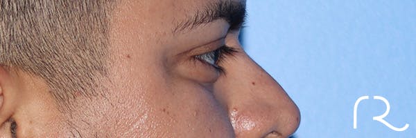 Eyelid Surgery Before & After Gallery - Patient 327450 - Image 6