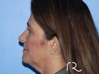 Facelift Before & After Gallery - Patient 401166 - Image 1